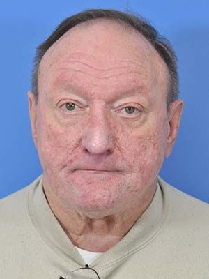 Rosacea And Rhinophyma Before & After