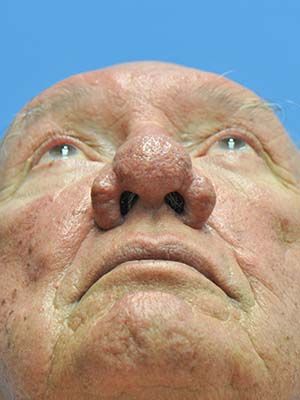 Rosacea And Rhinophyma Before & After