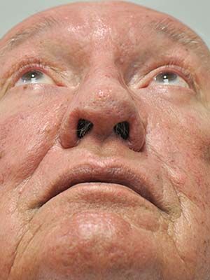 Rosacea And Rhinophyma Before & After