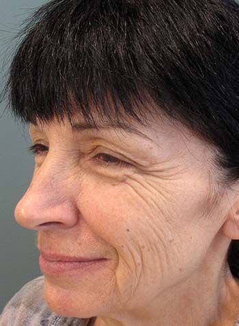 Botox Before & After