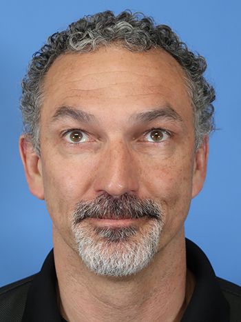 Botox Before & After