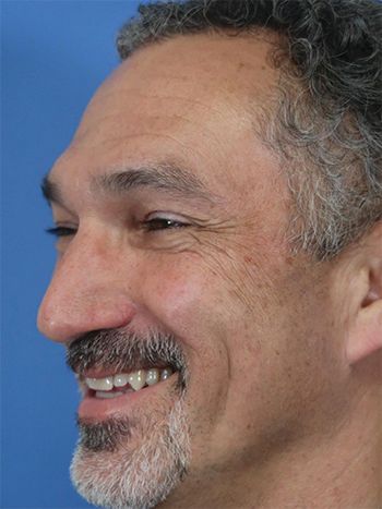 Botox Before & After