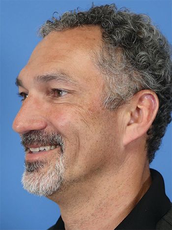 Botox Before & After