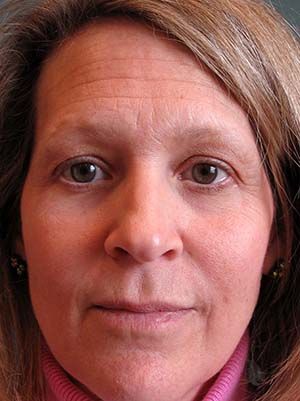 Botox Before & After