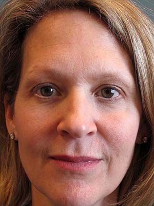 Botox Before & After