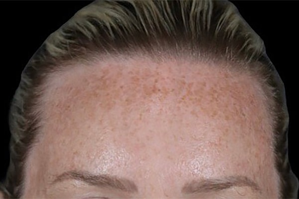 Laser Resurfacing Before & After