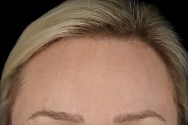 Laser Resurfacing Before & After
