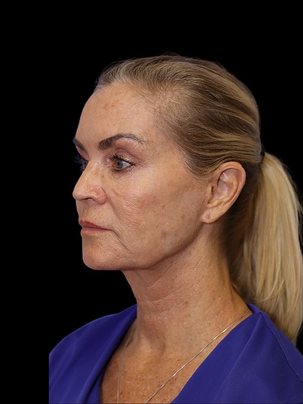 Laser Resurfacing Before & After