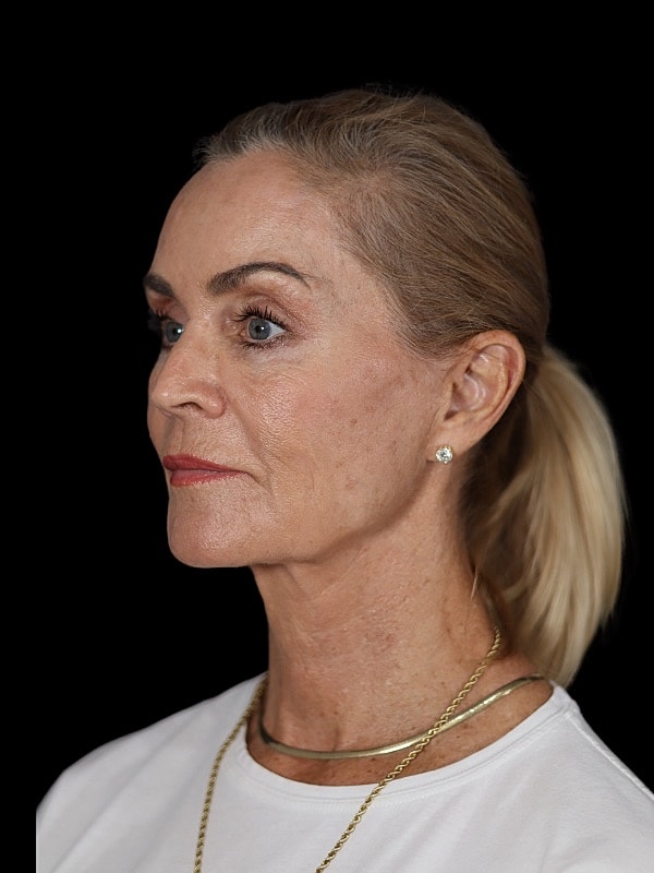 Laser Resurfacing Before & After