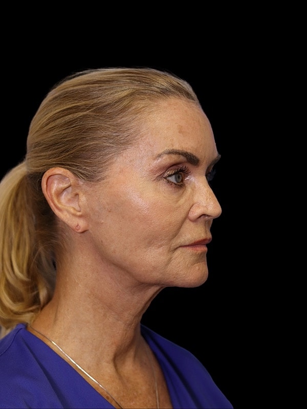 Laser Resurfacing Before & After