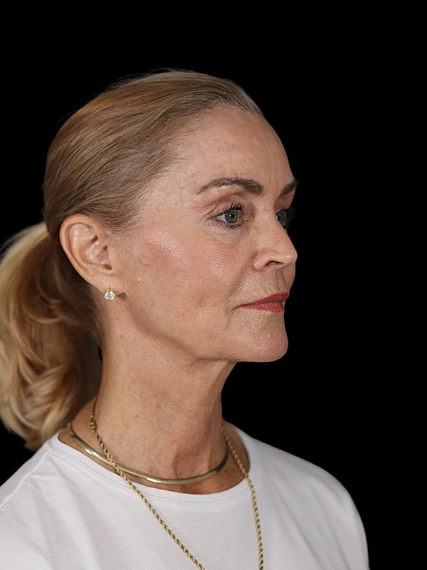 Laser Resurfacing Before & After