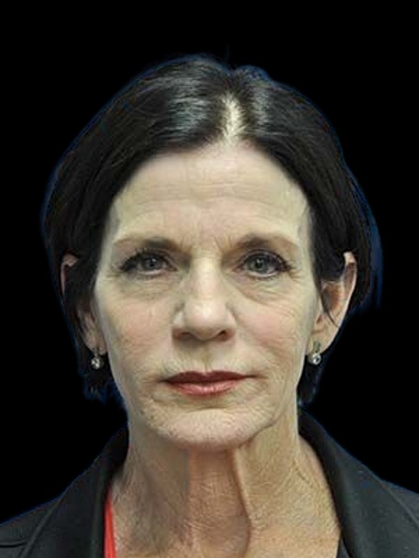 Laser Resurfacing Before & After