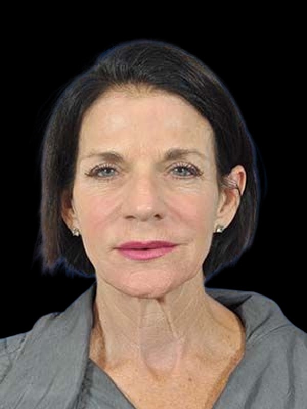 Laser Resurfacing Before & After