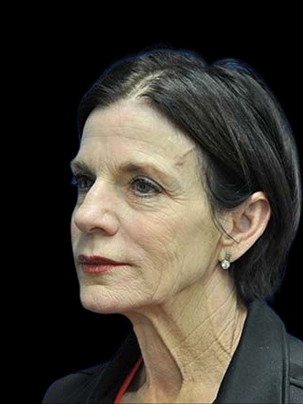 Laser Resurfacing Before & After