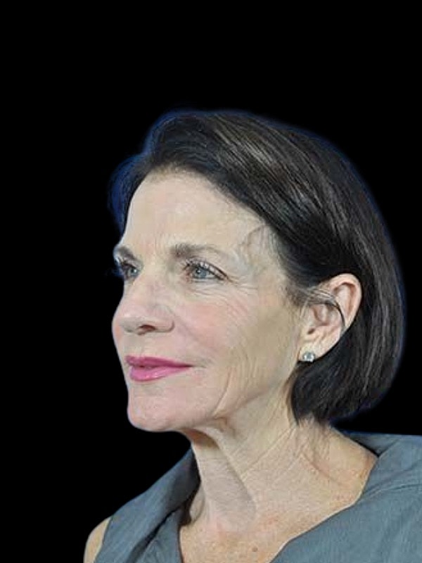 Laser Resurfacing Before & After