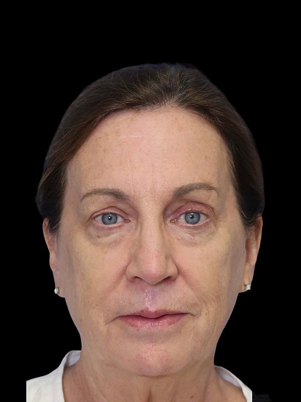 Laser Resurfacing Before & After 