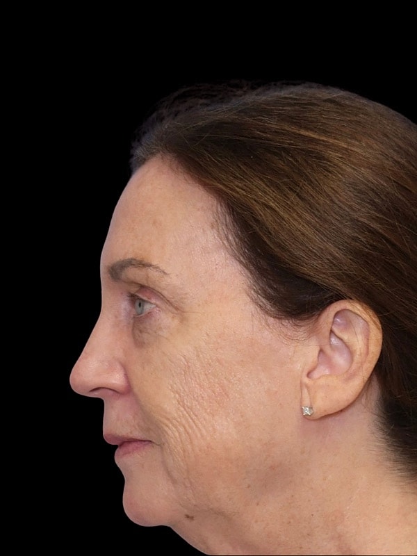 Laser Resurfacing Before & After