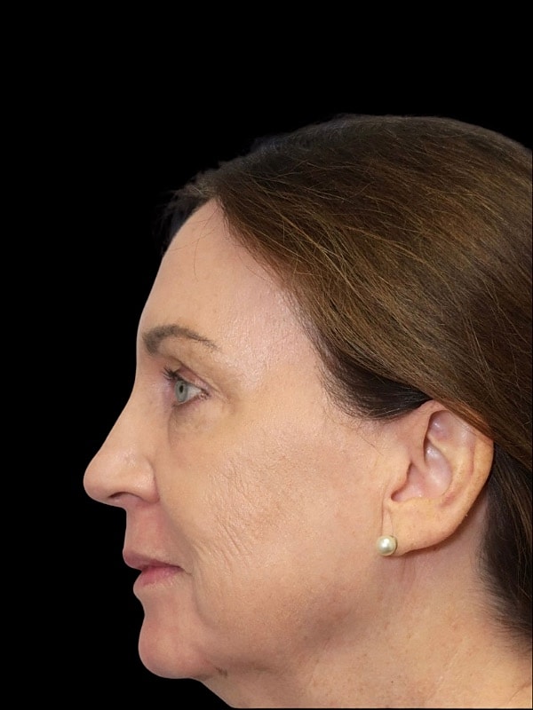 Laser Resurfacing Before & After
