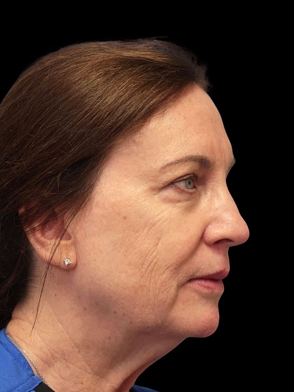 Laser Resurfacing Before & After