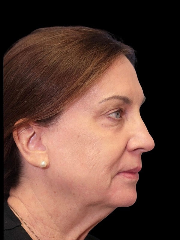 Laser Resurfacing Before & After