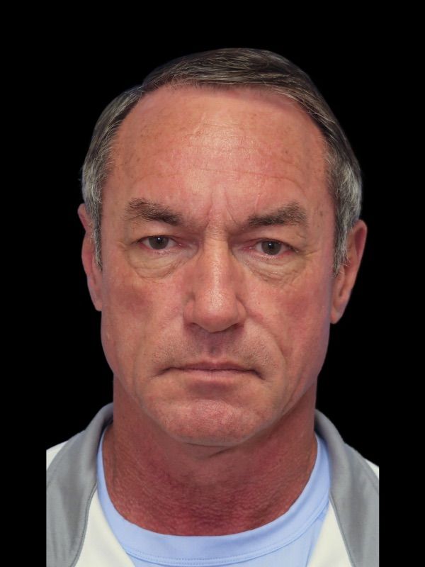 Deep Necklift Before & After