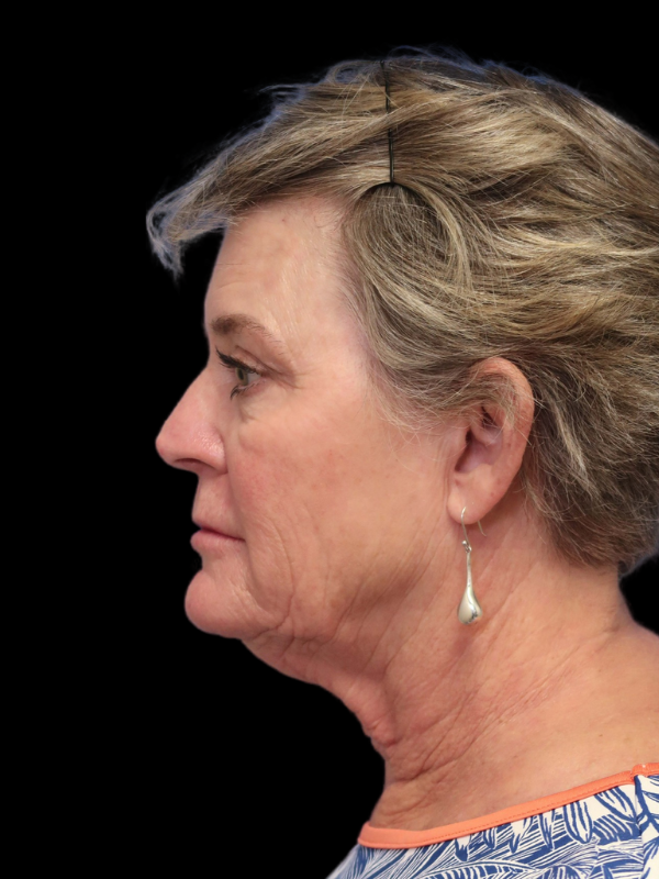 Deep Necklift Before & After