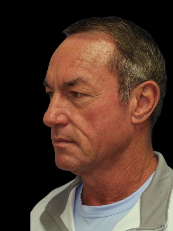 Deep Necklift Before & After