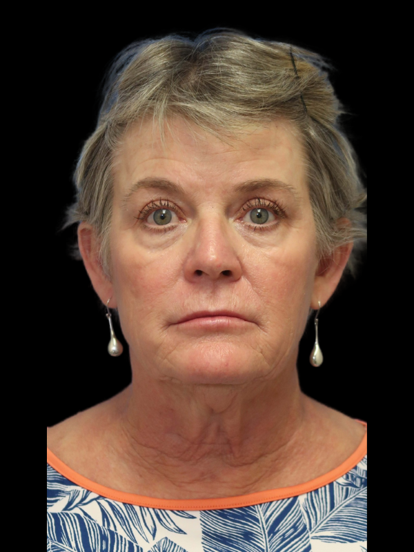 Deep Necklift Before & After
