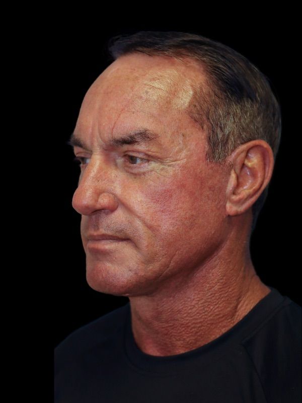 Deep Necklift Before & After