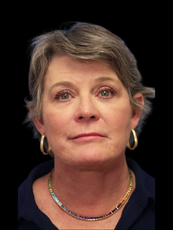 Deep Necklift Before & After