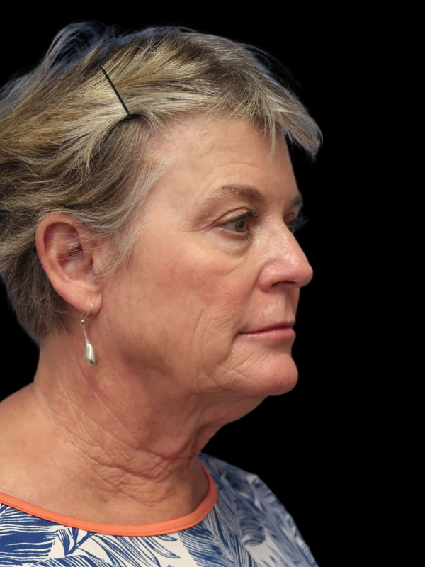 Deep Necklift Before & After