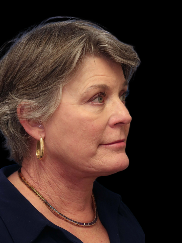 Deep Necklift Before & After