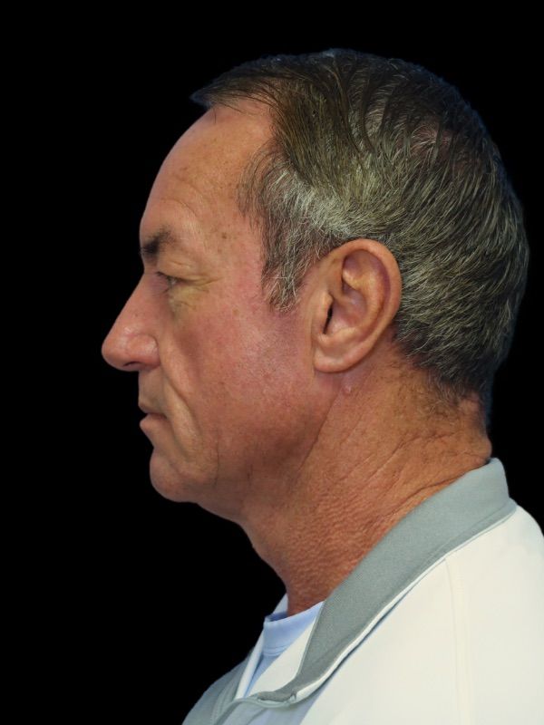 Deep Necklift Before & After