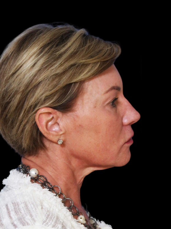 Deep Necklift Before & After