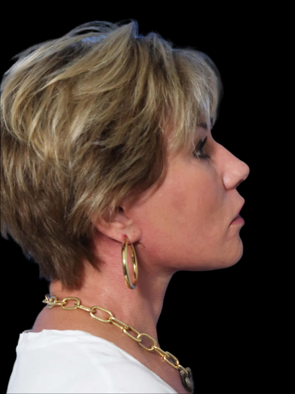 Deep Necklift Before & After