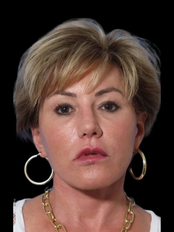 Deep Necklift Before & After