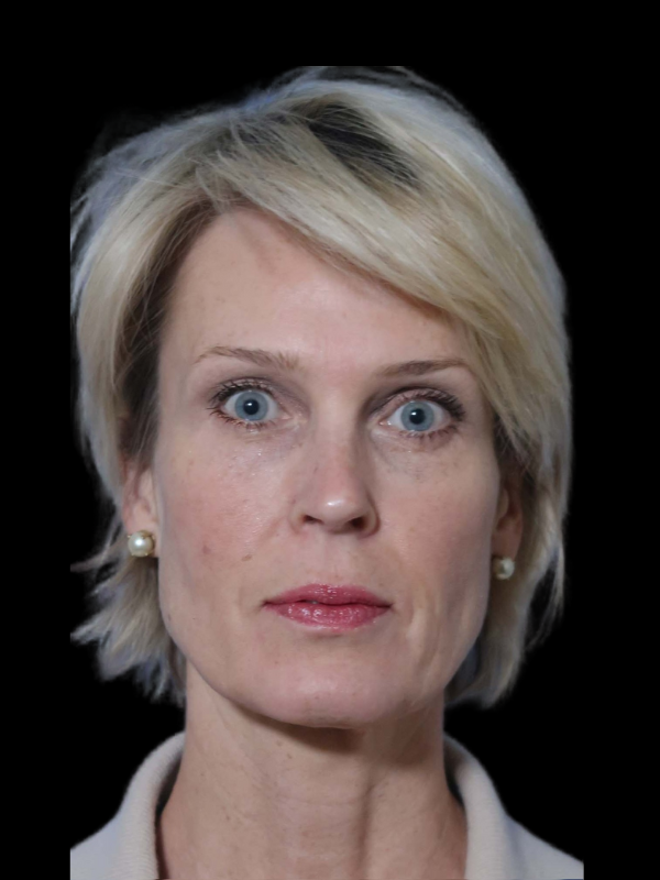 Deep Necklift Before & After