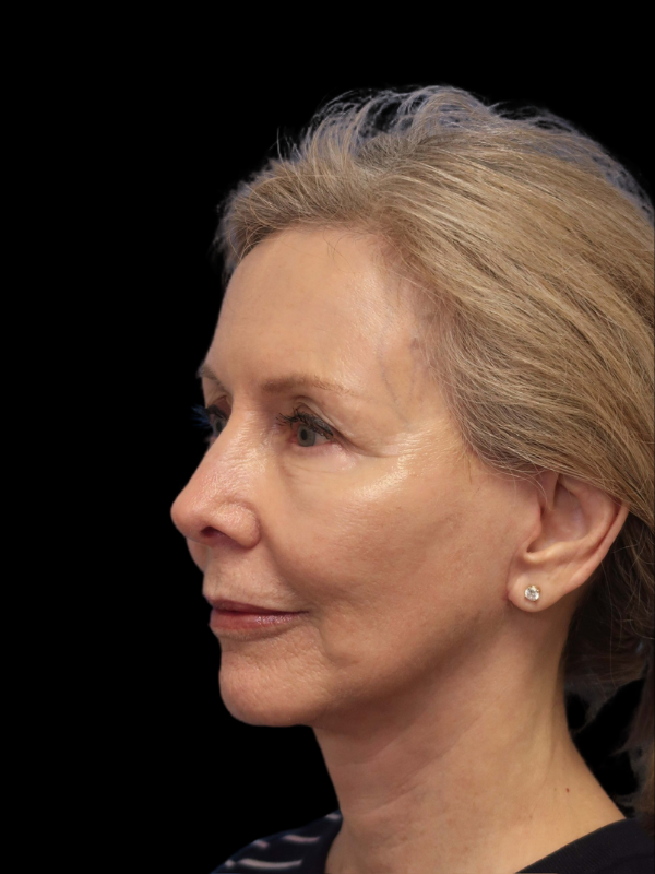 Deep Necklift Before & After