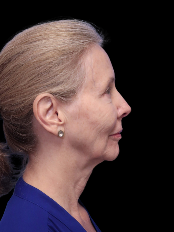 Deep Necklift Before & After