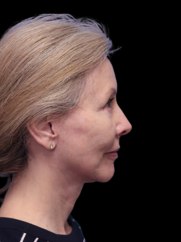 Deep Necklift Before & After