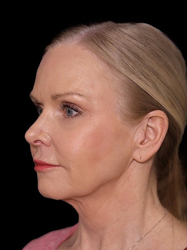 Deep Necklift Before & After