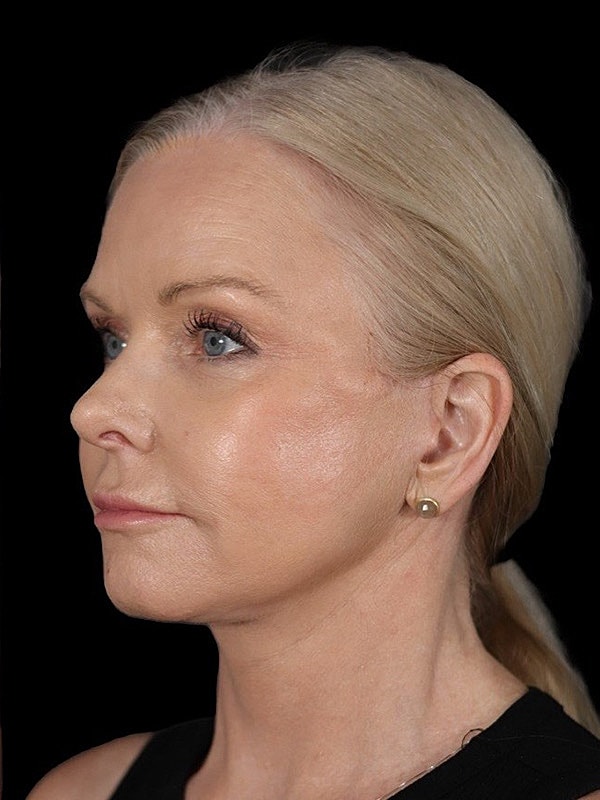 Deep Necklift Before & After