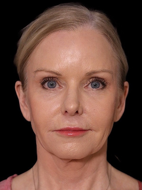 Deep Necklift Before & After