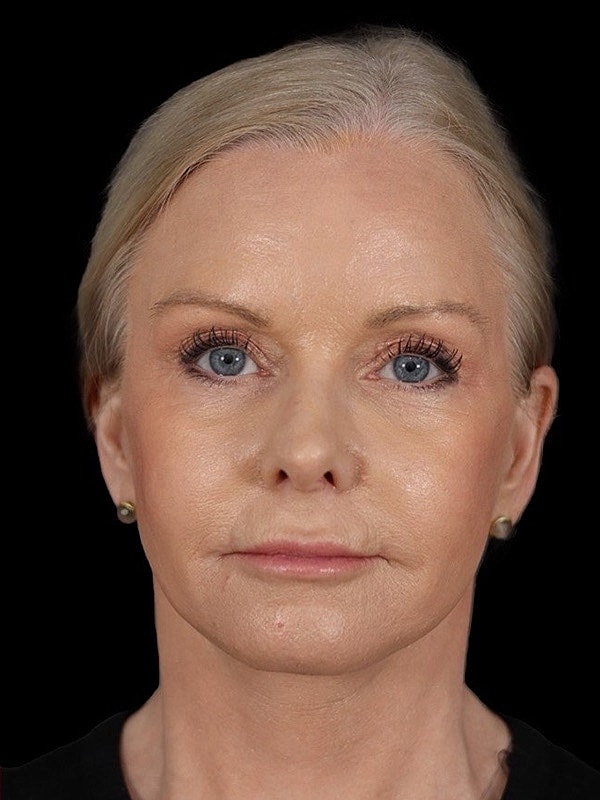Deep Necklift Before & After