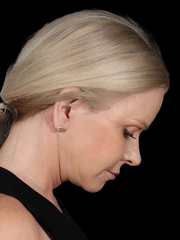 Deep Necklift Before & After