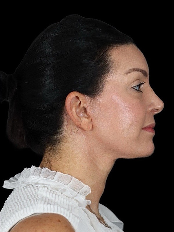 Deep Necklift Before & After