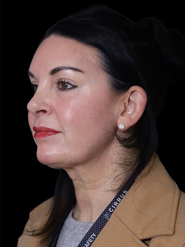 Deep Necklift Before & After