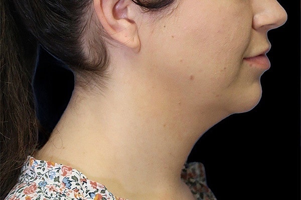 Deep Necklift Before & After