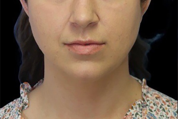 Deep Necklift Before & After