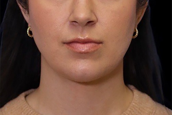 Deep Necklift Before & After